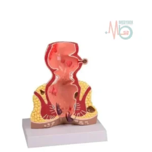 Diseased Hemorrohids Anatomy Education Model