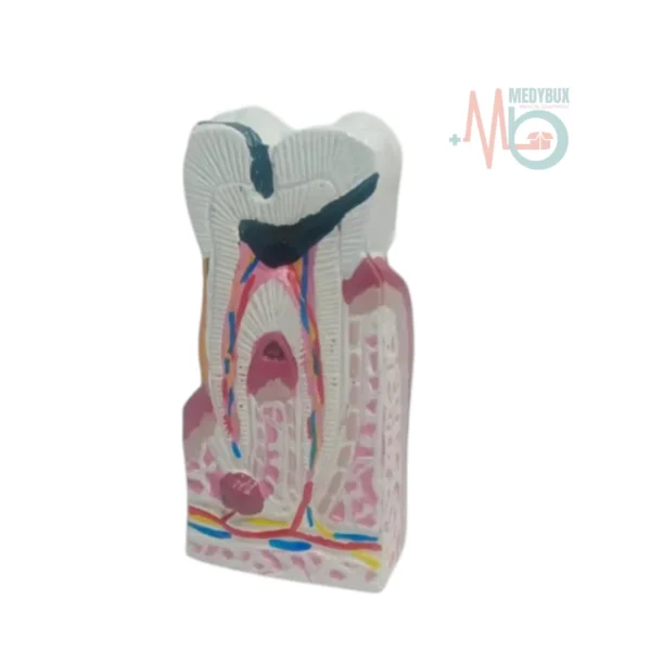 Diseased Tooth Model - Image 2