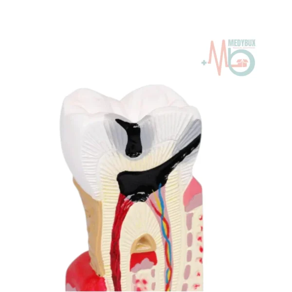 Diseased Tooth Model - Image 4