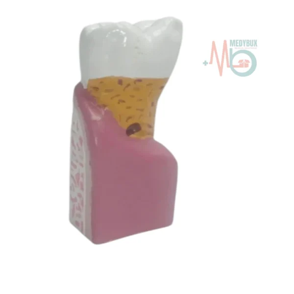 4 / 5 – Diseased Tooth Model (4).webp