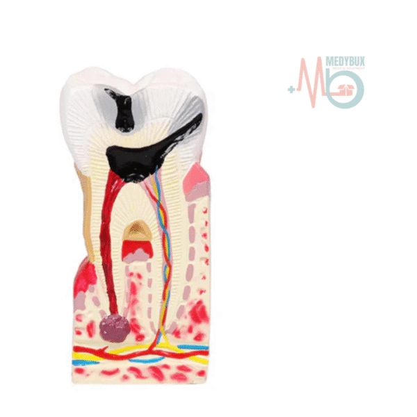 4 / 5 – Diseased Tooth Model (4).webp