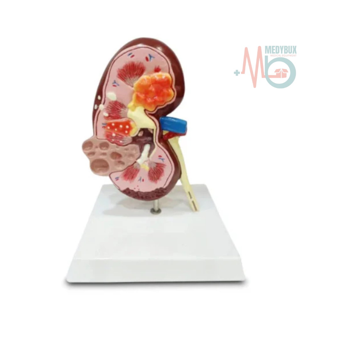 1 / 1 – Kidney Cyst Model Delux.png