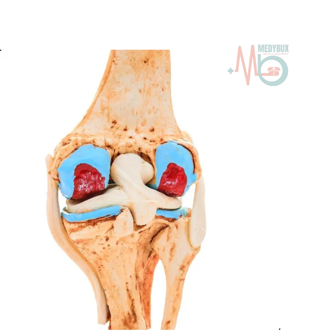 Knee Joint Arthritis Model 4 Stage Osteoarthritis For Demonstration & Orthopedic Use - Image 2
