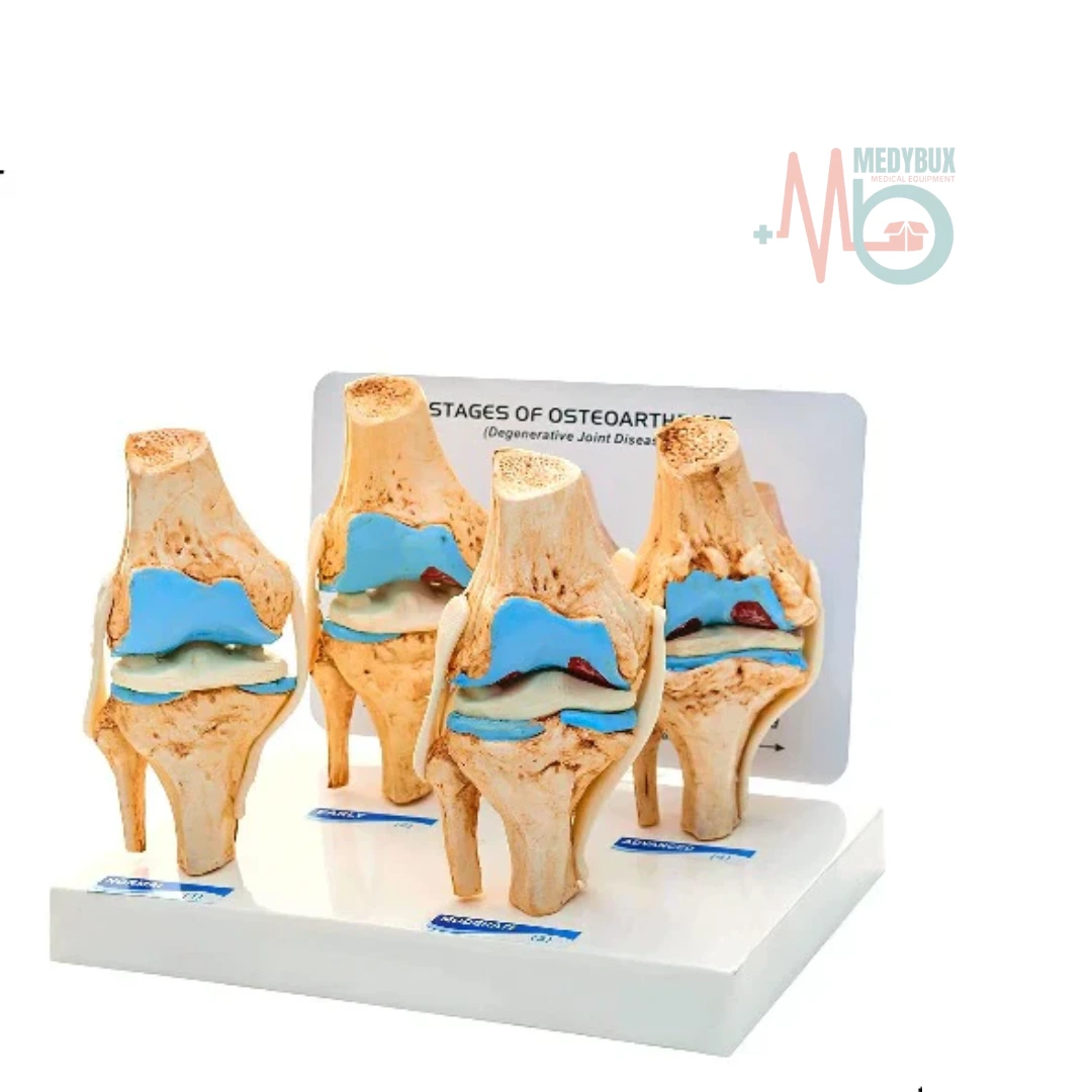 Knee Joint Arthritis Model 4 Stage Osteoarthritis For Demonstration & Orthopedic Use