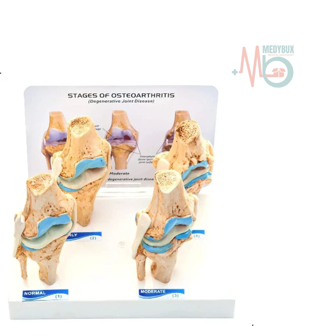 Knee Joint Arthritis Model 4 Stage Osteoarthritis For Demonstration & Orthopedic Use - Image 4