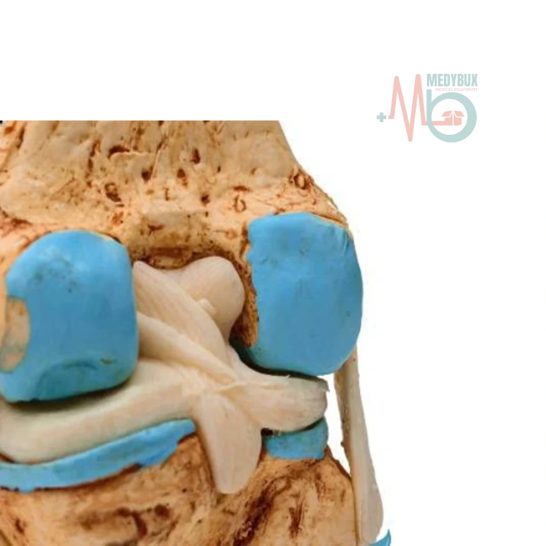 Knee Joint Arthritis Model 4 Stage Osteoarthritis For Demonstration & Orthopedic Use - Image 3